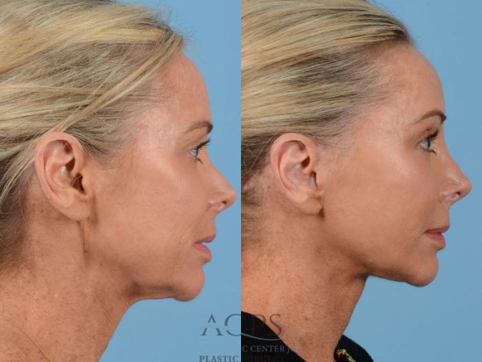 Before & After Brow Lift Case 1350 Side View: View in Houston, TX