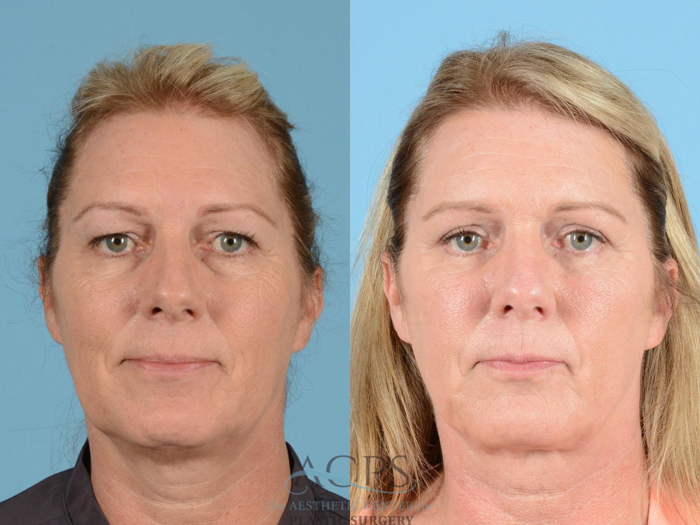 Before & After Brow Lift Case 1351 Front View: View in Houston, TX
