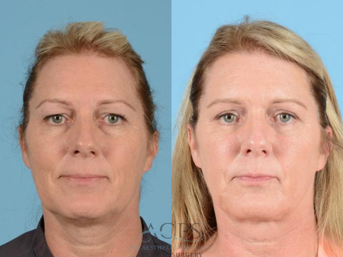 Before & After Brow Lift Case 1351 Front View: View in Houston, TX