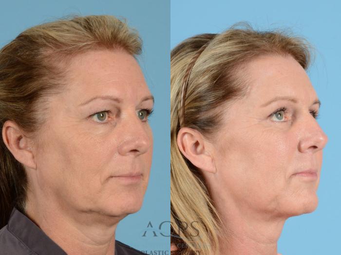 Before & After Brow Lift Case 1351 Oblique View: View in Houston, TX
