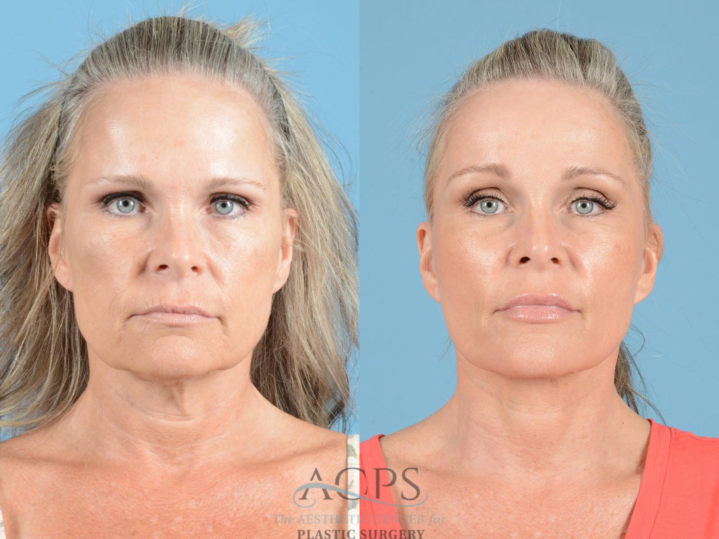 Before & After Brow Lift Case 1352 Front View: View in Houston, TX