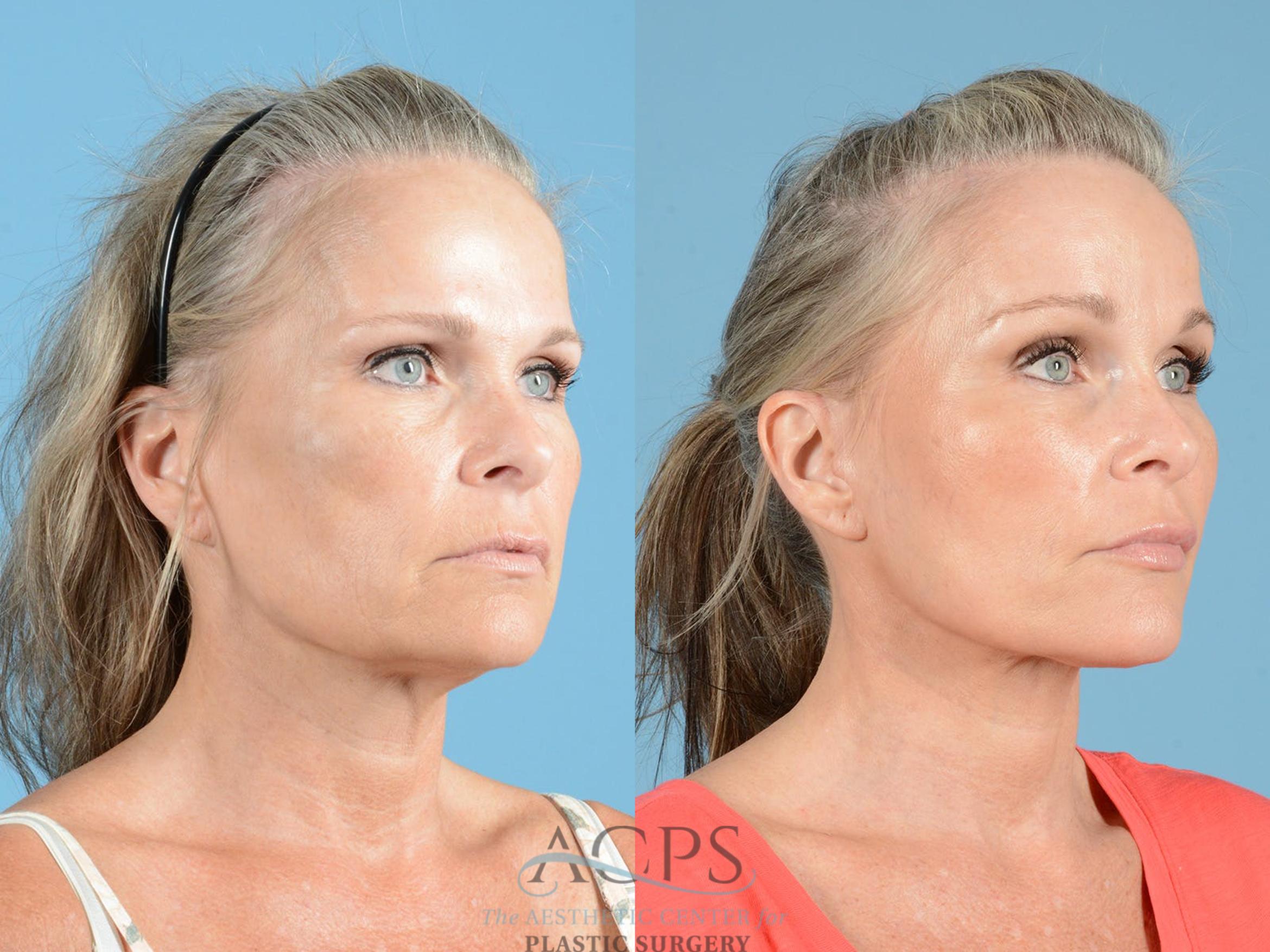 Before & After Brow Lift Case 1352 Oblique View: View in Houston, TX
