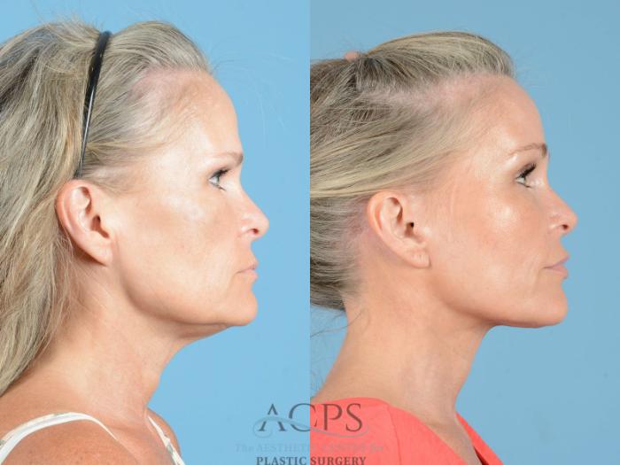 Before & After Brow Lift Case 1352 Side View: View in Houston, TX