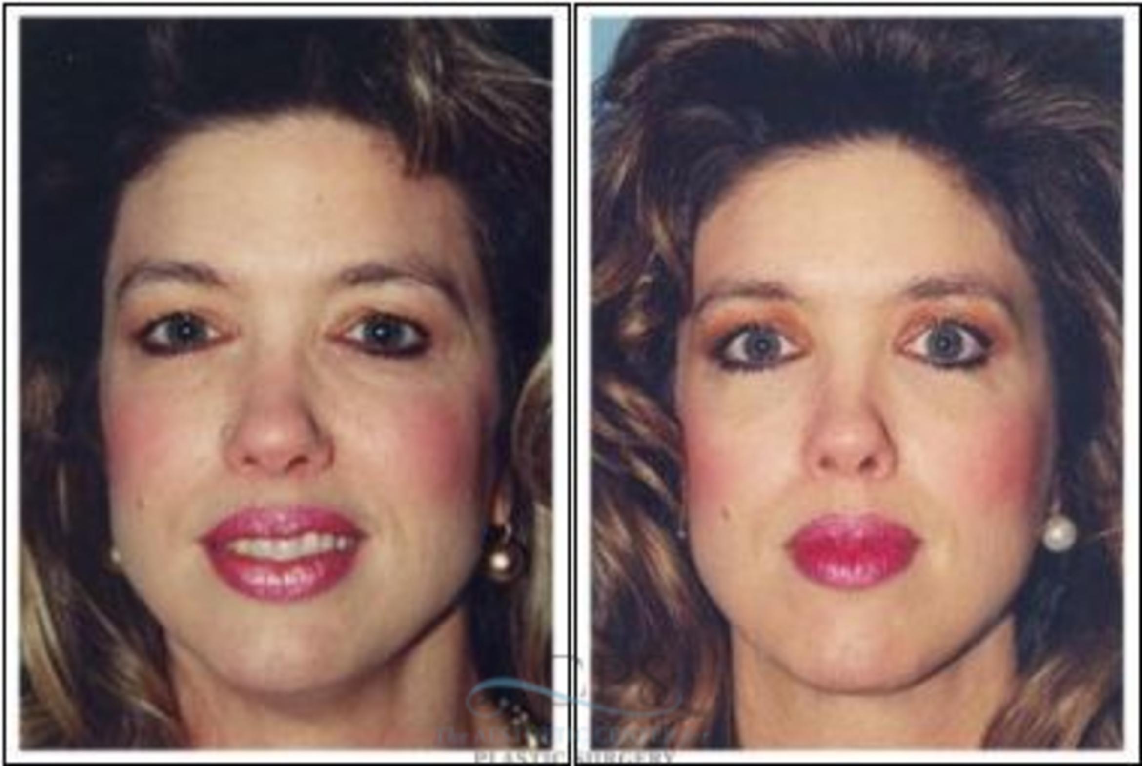 Before & After Brow Lift Case 1357 Front View: View in Houston, TX