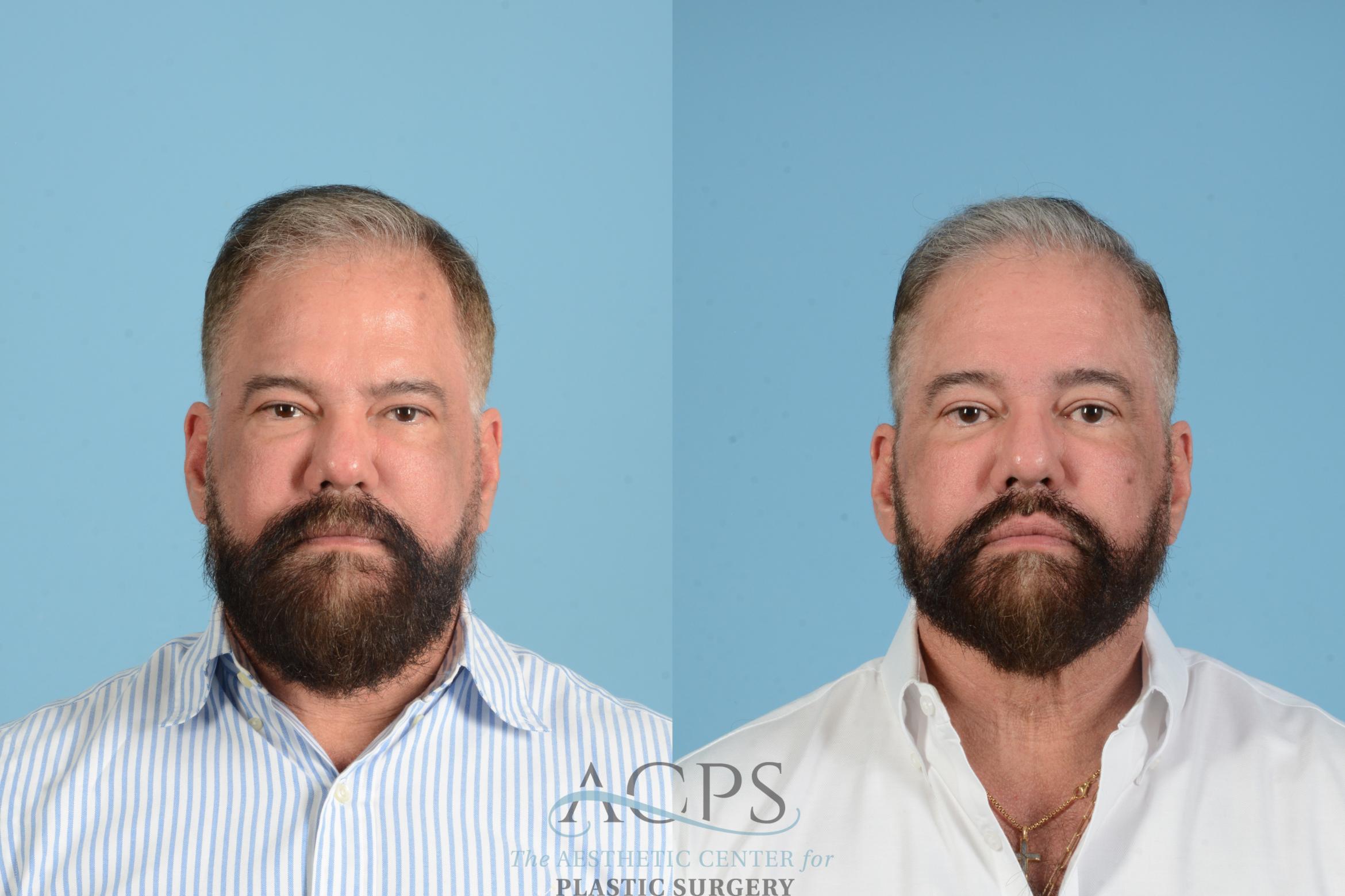 Before & After Brow Lift Case 1561 Front View in Houston, TX