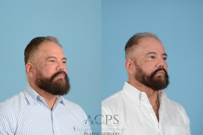 Before & After Brow Lift Case 1561 Left Oblique View in Houston, TX