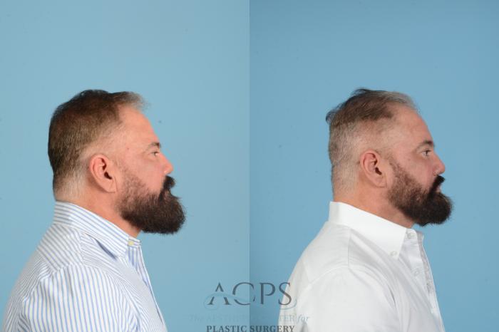 Before & After Brow Lift Case 1561 Left Side View in Houston, TX