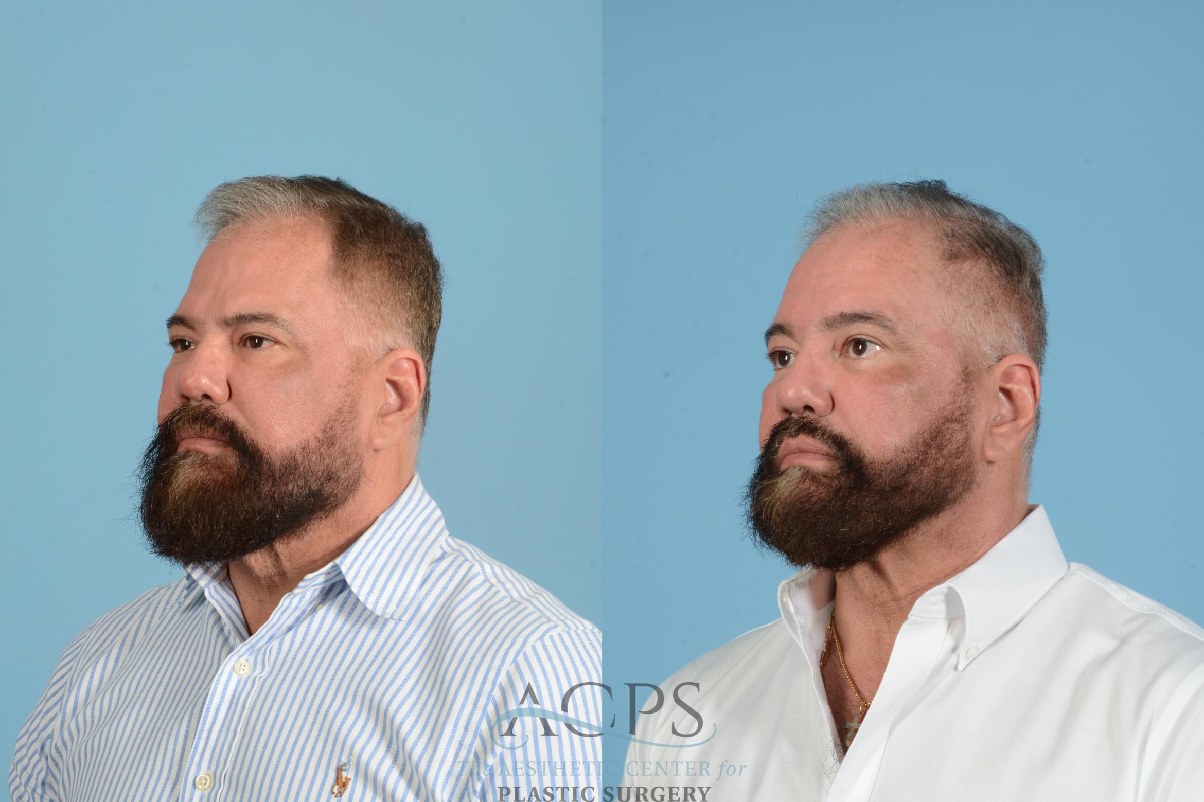 Before & After Brow Lift Case 1561 Right Oblique View in Houston, TX