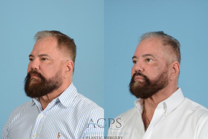 Before & After Brow Lift Case 1561 Right Oblique View in Houston, TX