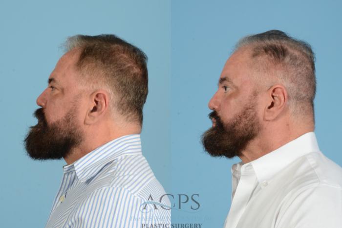 Before & After Brow Lift Case 1561 Right Side View in Houston, TX