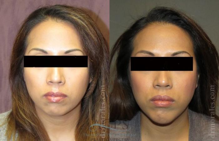 Before & After Chin Augmentation Case 1360 Front View: View in Houston, TX