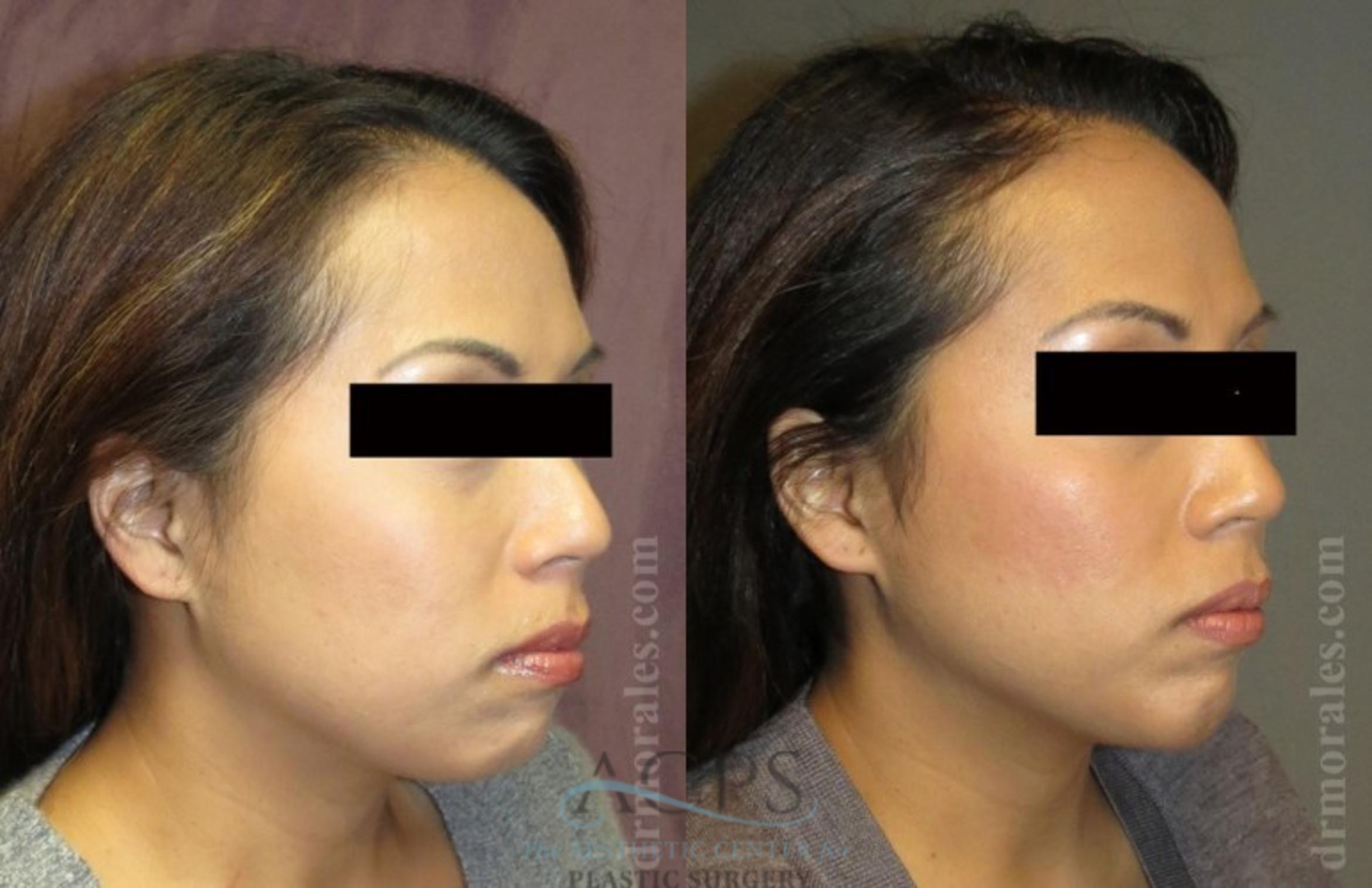 Before & After Chin Augmentation Case 1360 Oblique View: View in Houston, TX
