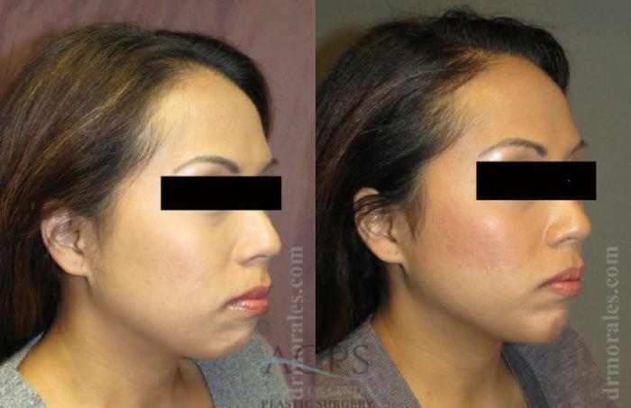 Before & After Chin Augmentation Case 1360 Oblique View: View in Houston, TX