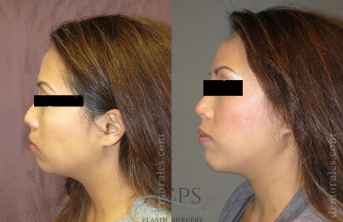 Before & After Chin Augmentation Case 1360 Side View: View in Houston, TX