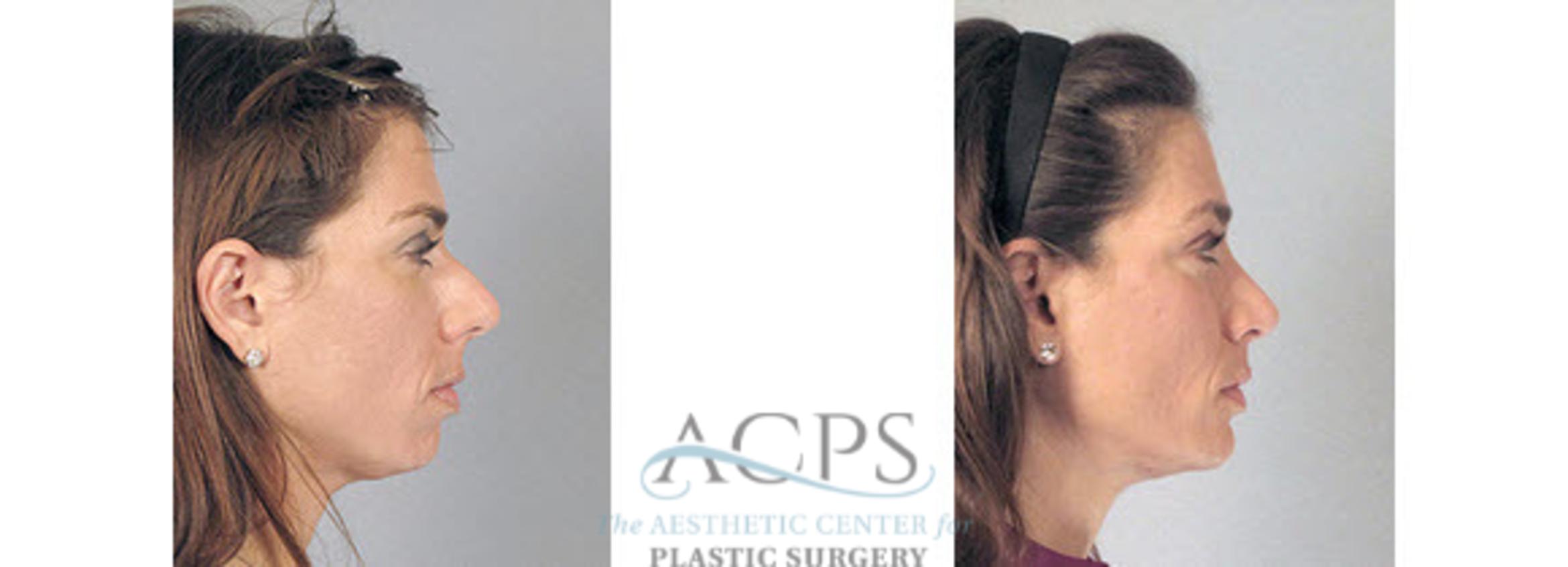Before & After Chin Augmentation Case 1361 Side View: View in Houston, TX