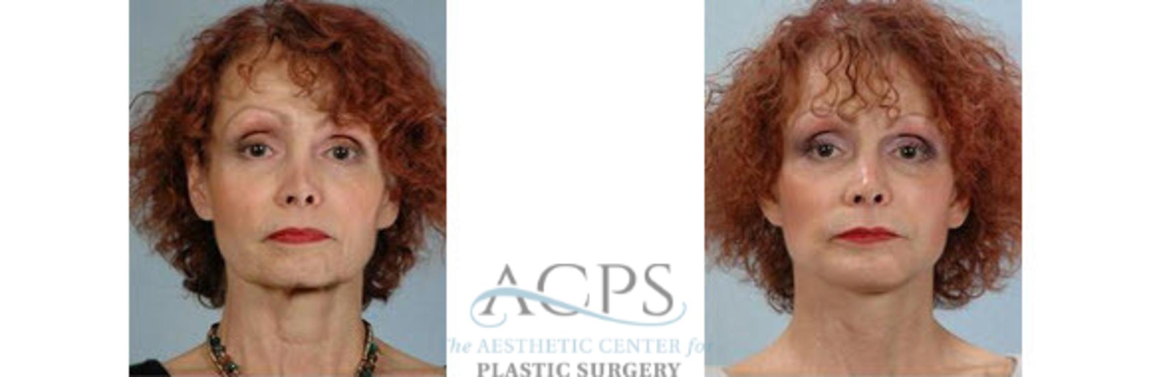 Before & After Chin Augmentation Case 1362 Front View: View in Houston, TX