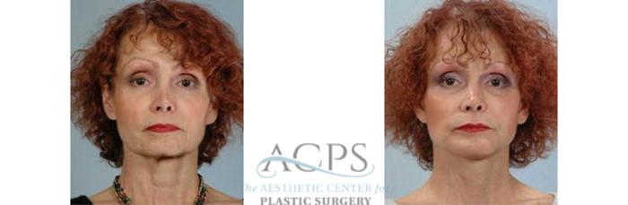 Before & After Chin Augmentation Case 1362 Front View: View in Houston, TX
