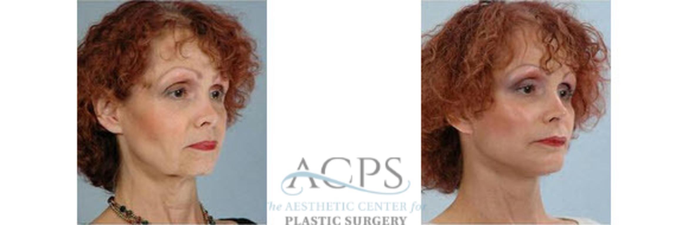 Before & After Chin Augmentation Case 1362 Oblique View: View in Houston, TX
