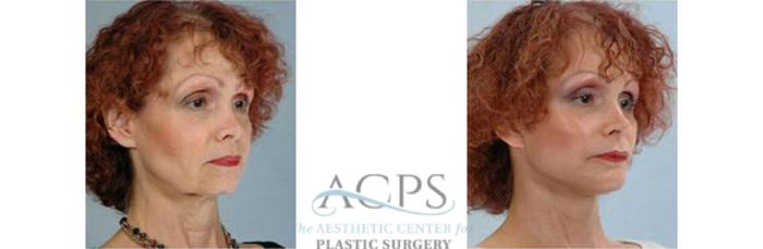 Before & After Chin Augmentation Case 1362 Oblique View: View in Houston, TX