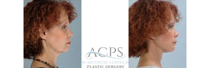 Before & After Chin Augmentation Case 1362 Side View: View in Houston, TX