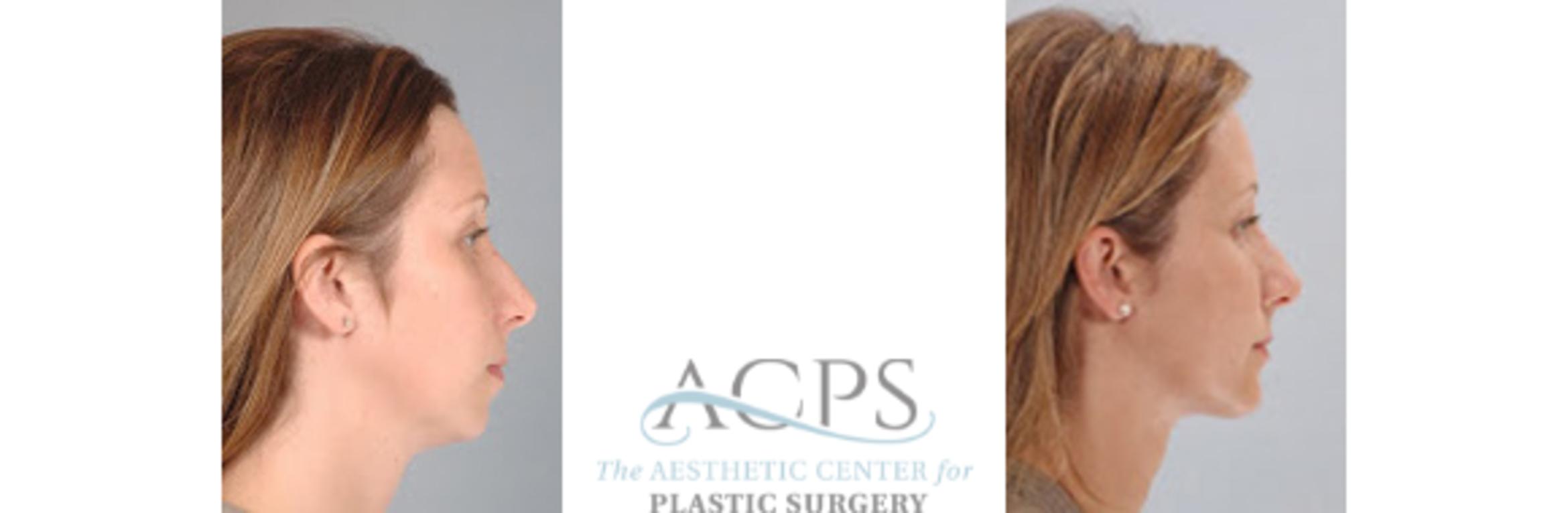 Before & After Chin Augmentation Case 1363 Side View: View in Houston, TX