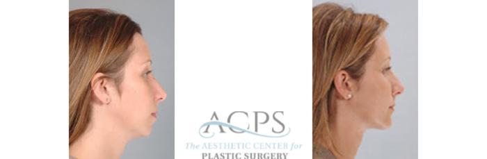 Before & After Chin Augmentation Case 1363 Side View: View in Houston, TX