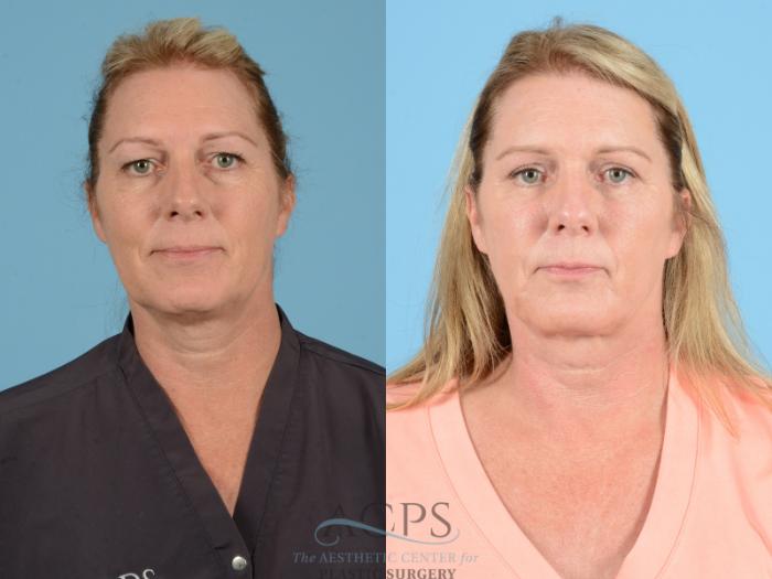 Before & After Eyelid Surgery Case 1277 Front View: View in Houston, TX