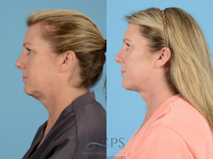 Before & After Eyelid Surgery Case 1277 Left Side View: View in Houston, TX