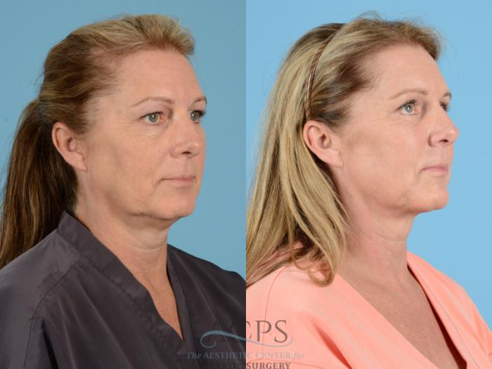 Before & After Eyelid Surgery Case 1277 Oblique View: View in Houston, TX