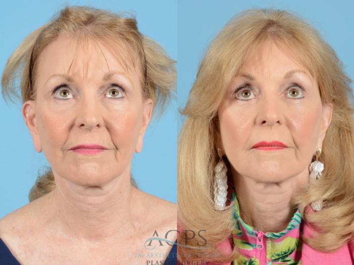 Before & After Eyelid Surgery Case 1278 Front - Eyes Raised View: View in Houston, TX