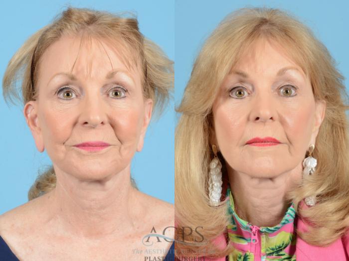 Before & After Eyelid Surgery Case 1278 Front View: View in Houston, TX