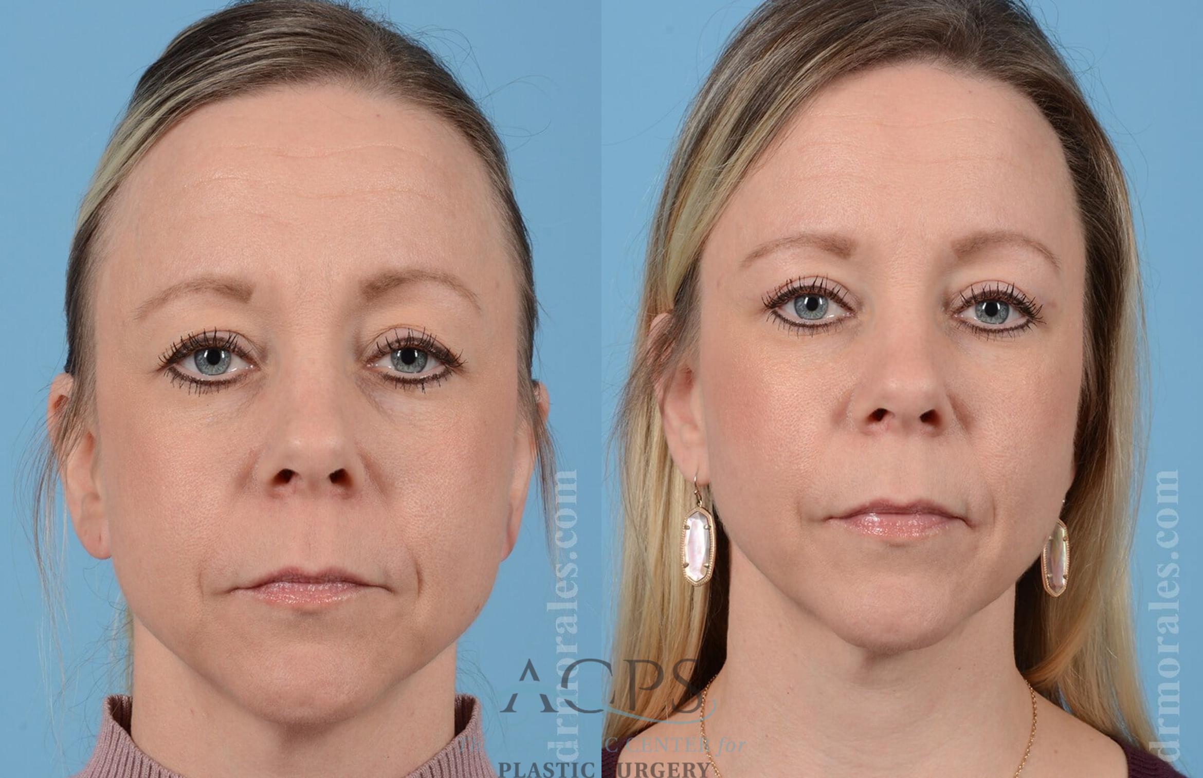 Before & After Eyelid Surgery Case 1281 Front View: View in Houston, TX