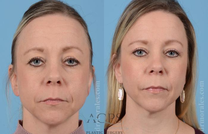 Before & After Eyelid Surgery Case 1281 Front View: View in Houston, TX