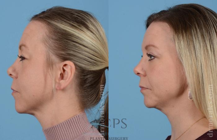 Before & After Eyelid Surgery Case 1281 Side View: View in Houston, TX