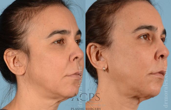 Before & After Eyelid Surgery Case 1282 Oblique View: View in Houston, TX