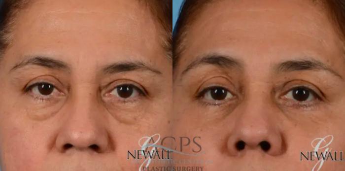 Before & After Eyelid Surgery Case 1283 Front View: View in Houston, TX