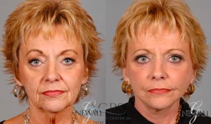 Before & After Eyelid Surgery Case 1284 Front View: View in Houston, TX
