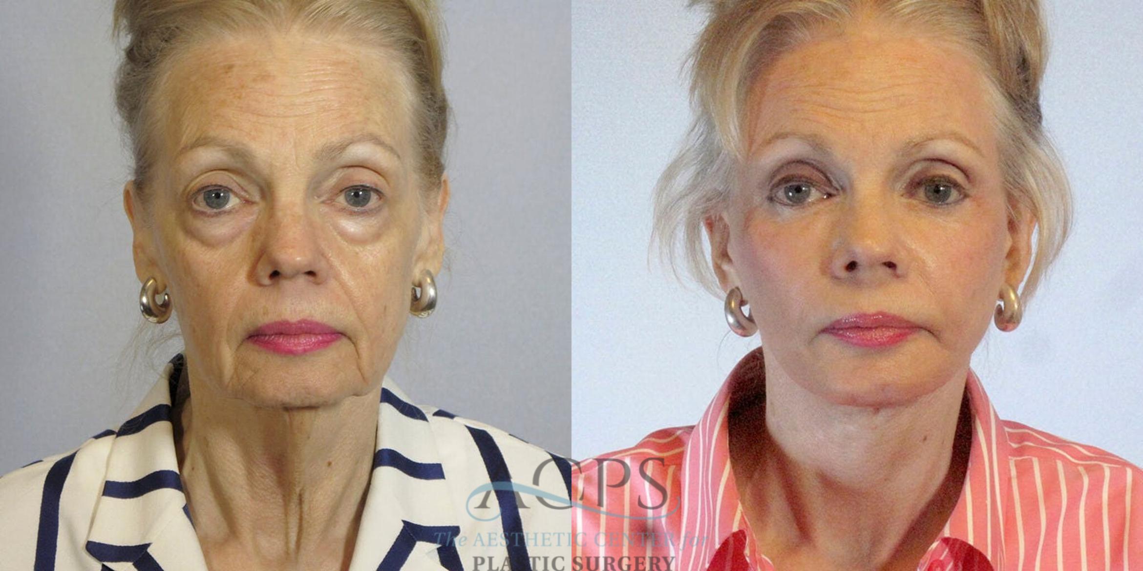 Before & After Eyelid Surgery Case 1285 Front View: View in Houston, TX