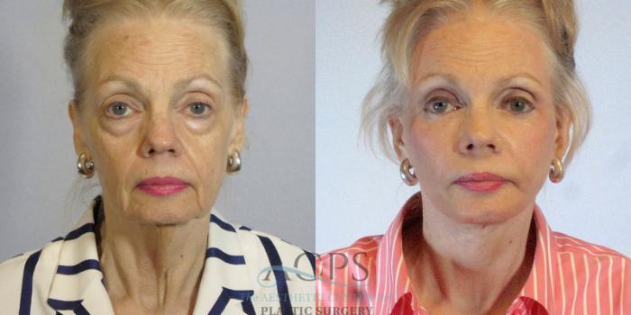 Before & After Eyelid Surgery Case 1285 Front View: View in Houston, TX