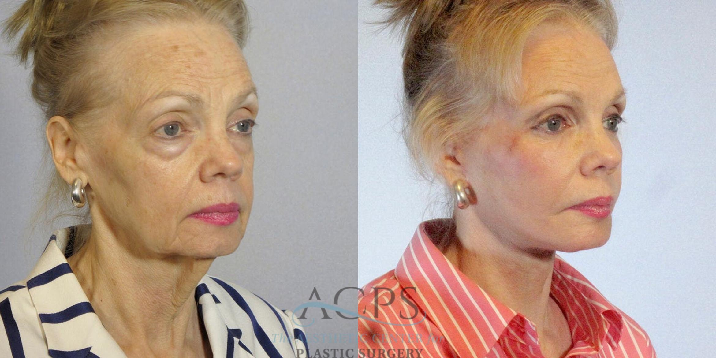 Before & After Eyelid Surgery Case 1285 Oblique View: View in Houston, TX