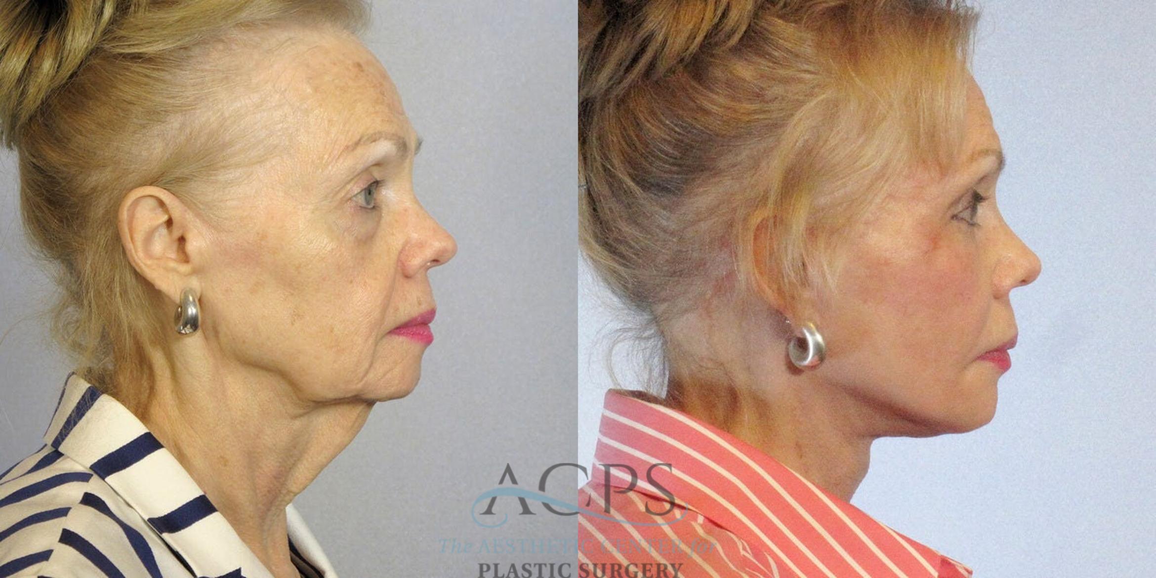 Before & After Eyelid Surgery Case 1285 Side View: View in Houston, TX