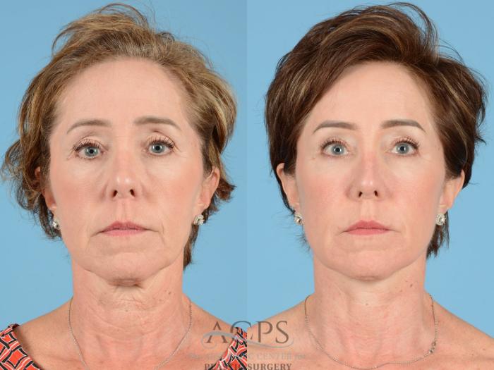 Before & After Eyelid Surgery Case 1286 Front View: View in Houston, TX