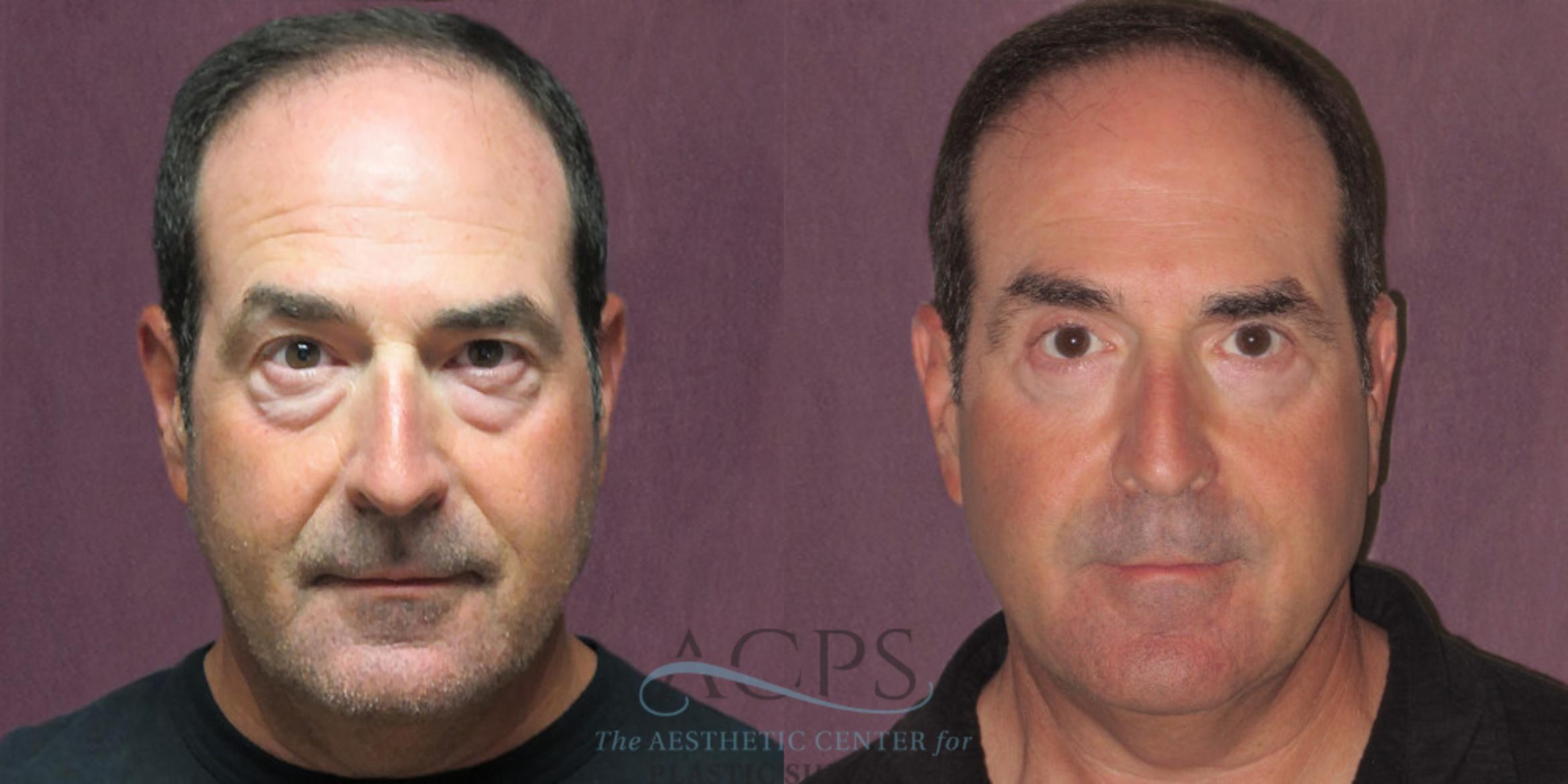 Before & After Eyelid Surgery Case 1289 Front View: View in Houston, TX
