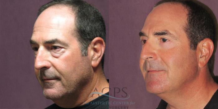 Before & After Eyelid Surgery Case 1289 Oblique Left View: View in Houston, TX