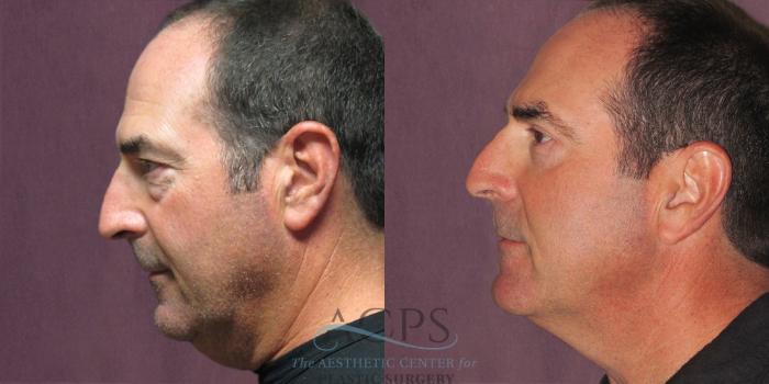 Before & After Eyelid Surgery Case 1289 Side Left View: View in Houston, TX