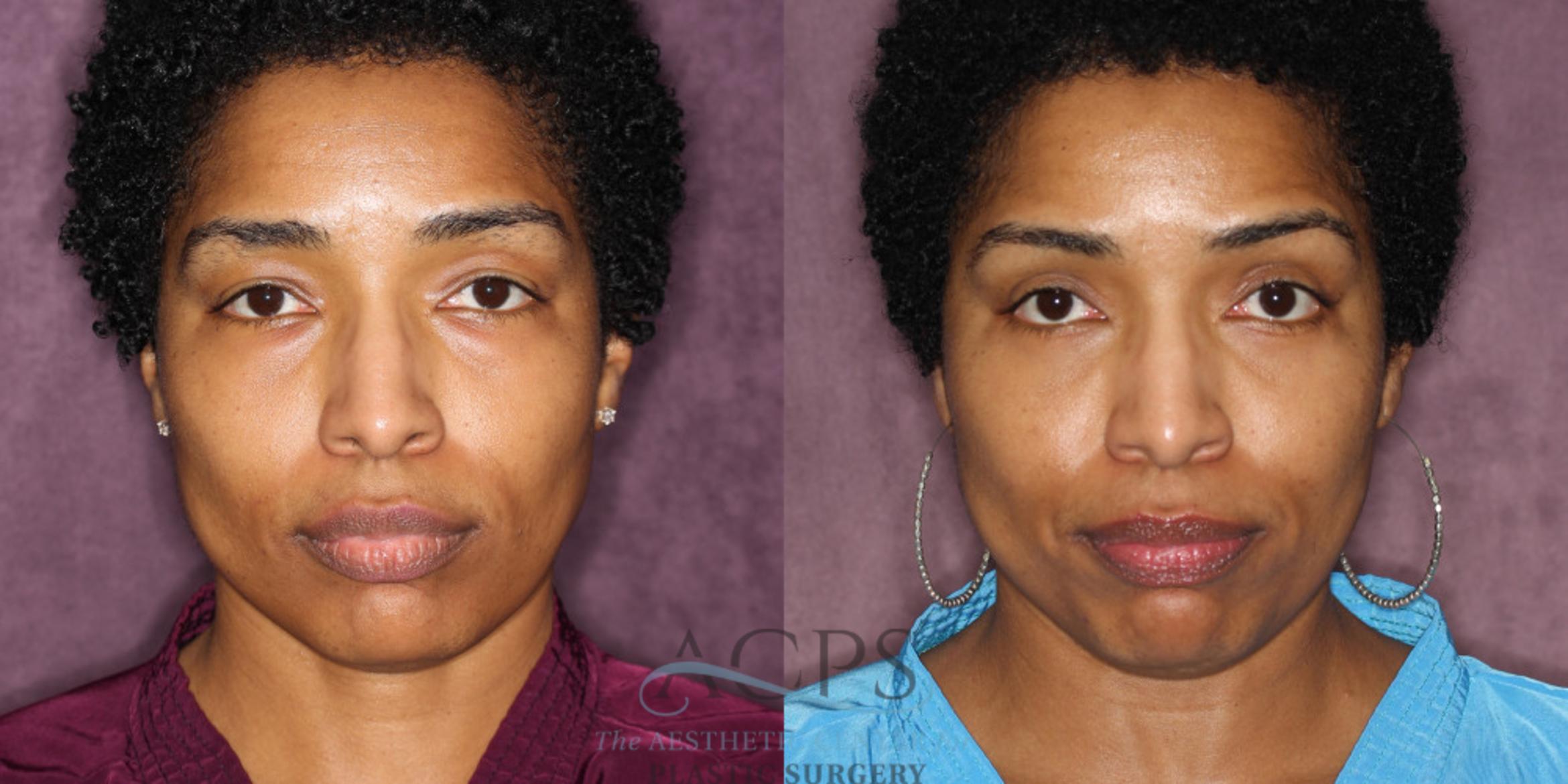 Before & After Eyelid Surgery Case 1292 Front View: View in Houston, TX