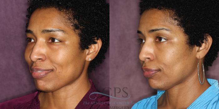 Before & After Eyelid Surgery Case 1292 Oblique Left View: View in Houston, TX