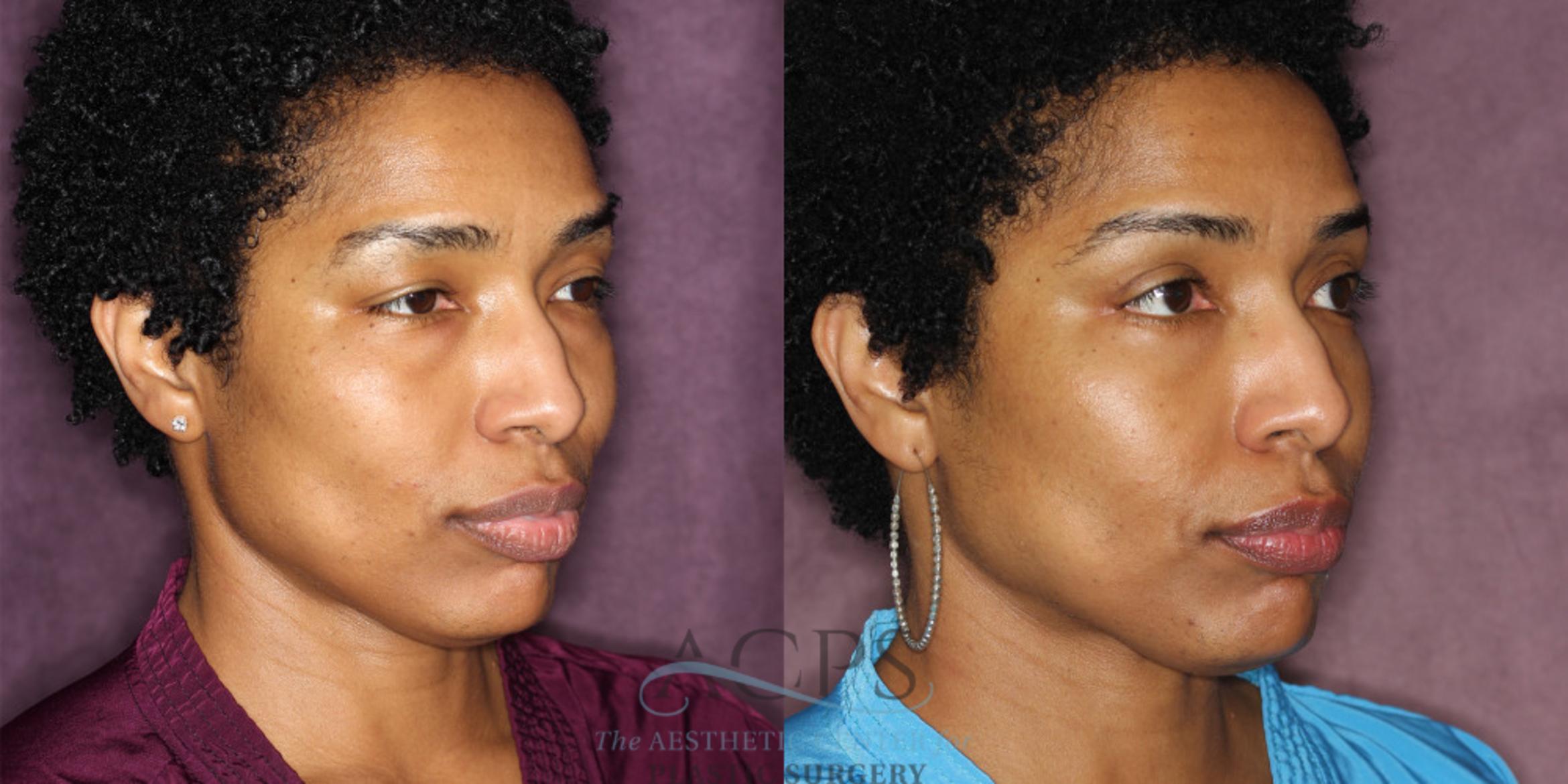 Before & After Eyelid Surgery Case 1292 Oblique Right View: View in Houston, TX