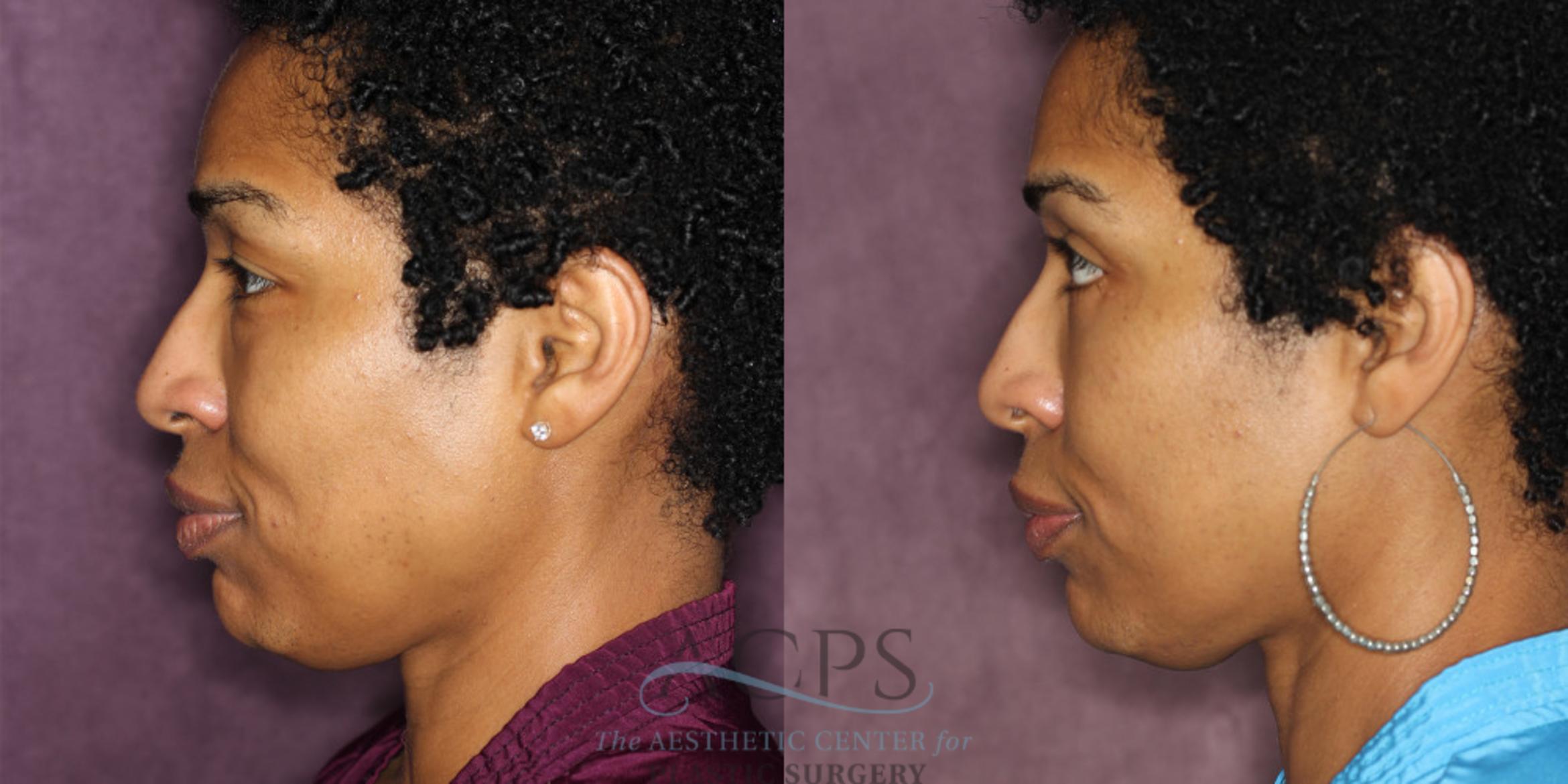 Before & After Eyelid Surgery Case 1292 Side Left View: View in Houston, TX