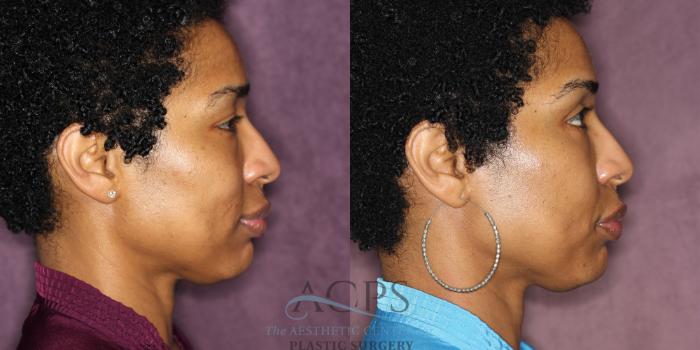 Before & After Eyelid Surgery Case 1292 Side Right View: View in Houston, TX